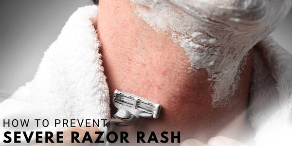 How to Prevent Severe Razor Rash